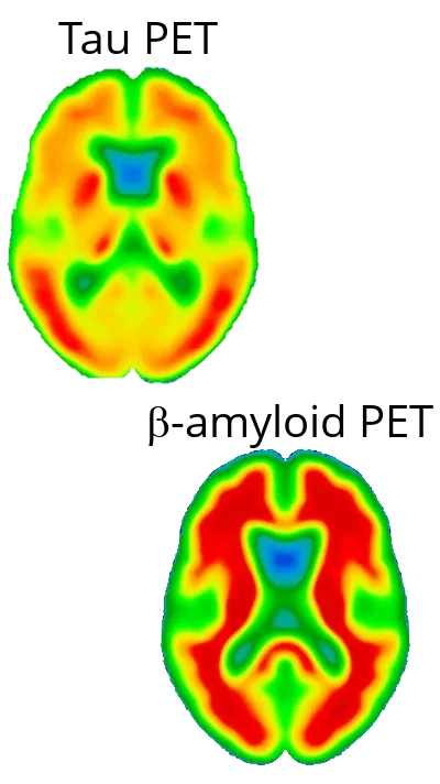 Tau and B-Amyloid PET images