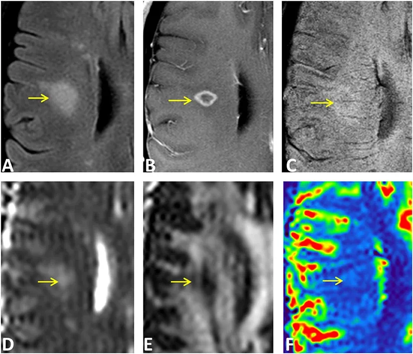 Multiple MRI modalities applied to a ring-enhancing lesion in an MS patient