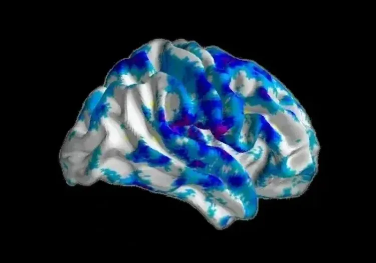 Change in Gray Matter Density in CBD Subjects