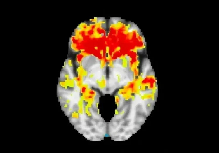 t-stat map of 12 month change from baseline in mean diffusivity for the bvFTD variant