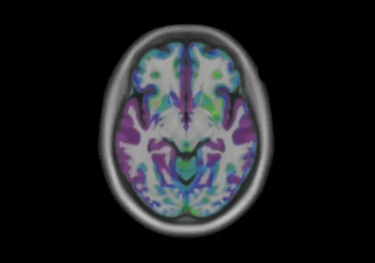 MRI scan of Brain Atrophy in Frontotemporal Dementia (FTD)