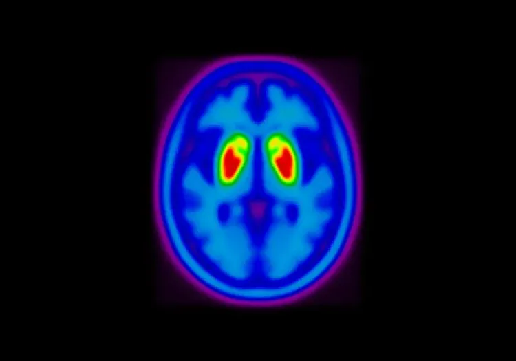 Pseudo DaTscan Image