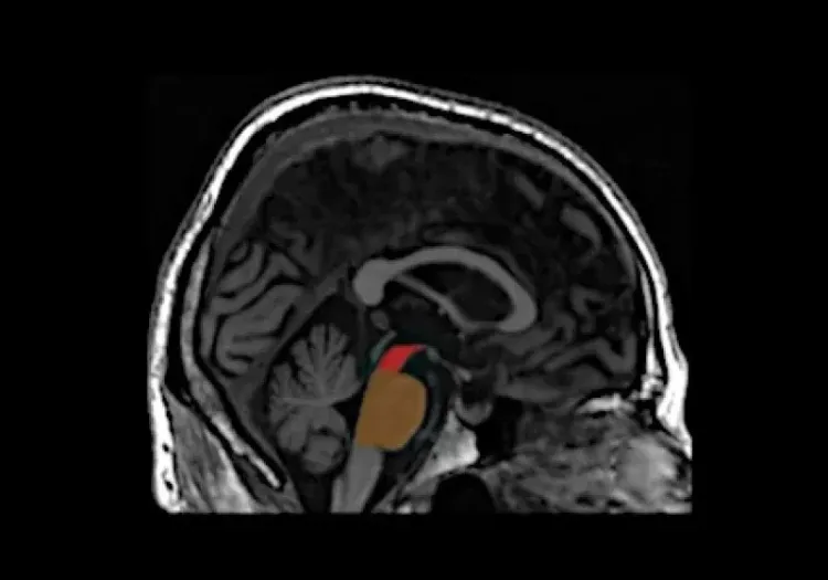 Illustration of Magnetic Resonance Parkinsonism Index 