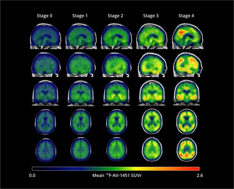その他 X tau MCIとアルツハイマー病におけるタウPETの経時的変化
