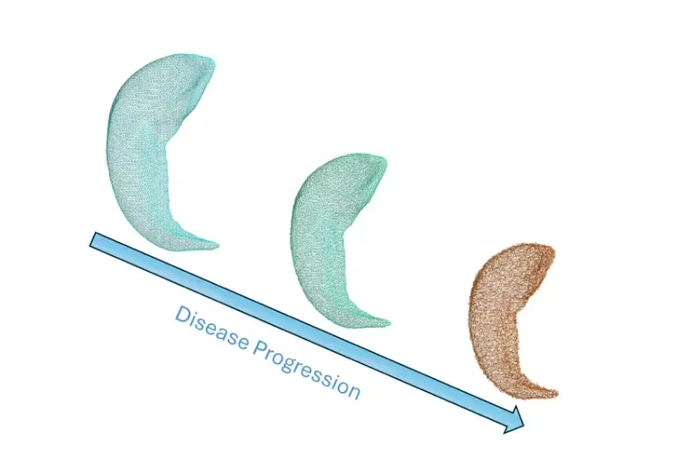Hippocampus shape changes as disease progresses