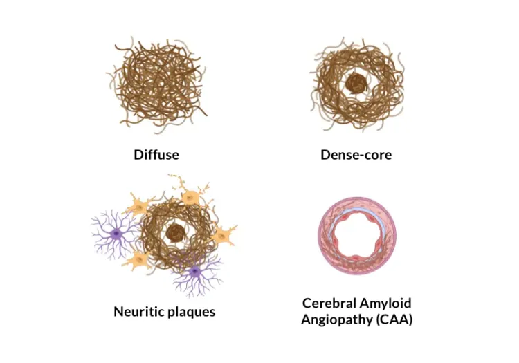 Various types of amyloid-β plaques