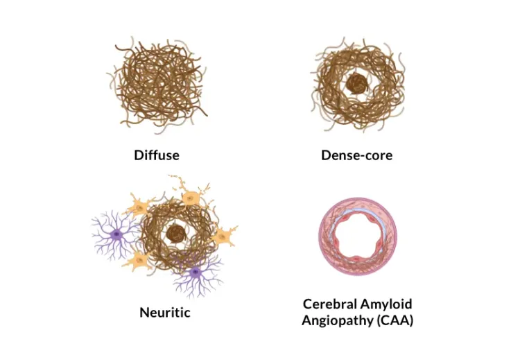 Various types of amyloid-β plaques