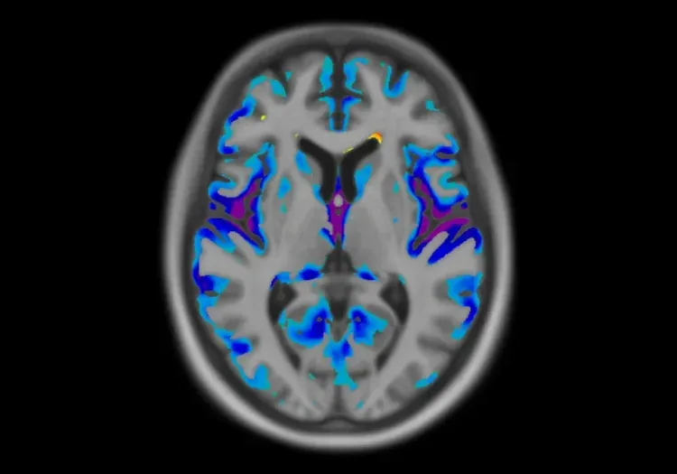 Tranche de cerveau montrant une dégénérescence corticobasale