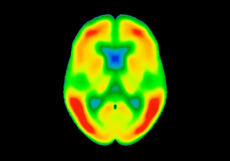 Tau et SUVR dans le cerveau