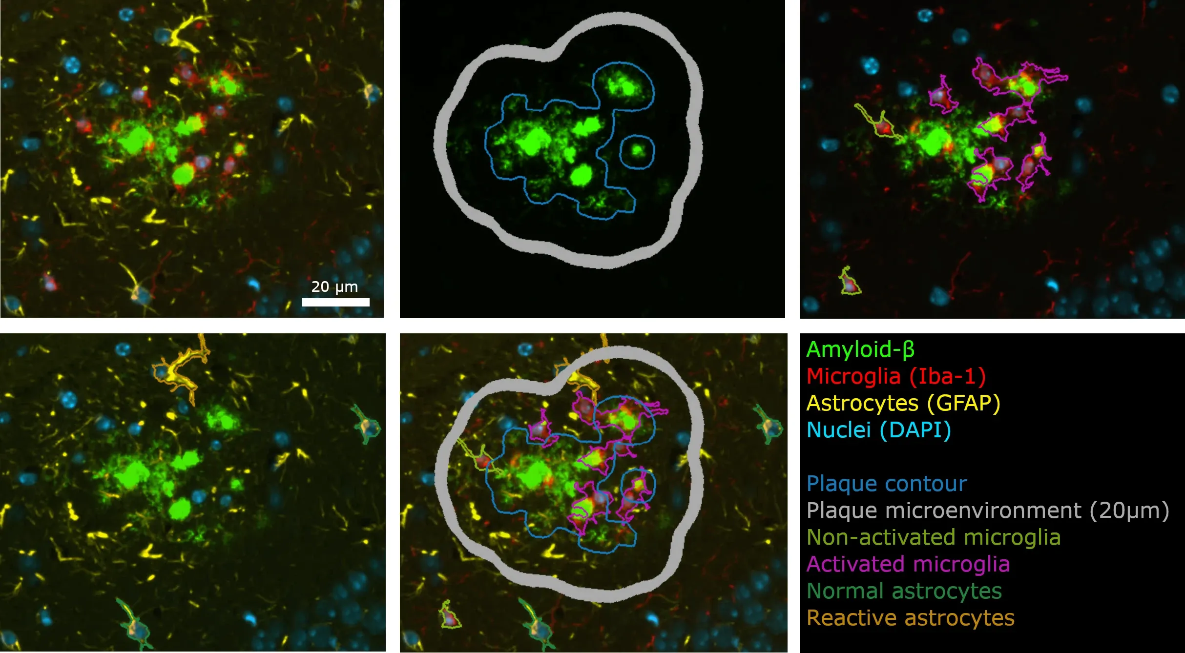 Montage de plaques amyloïdes