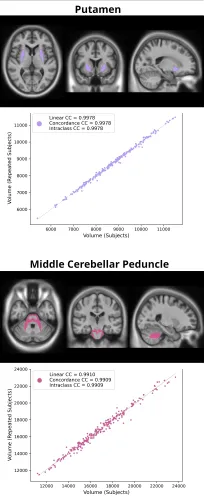 認知症・パーキンソン症候群　臨床と画像との対応　MRI ・SPECT 裁断済み 認知症・パーキンソン症候群 臨床と画像との対応 MRI・SPECTを
