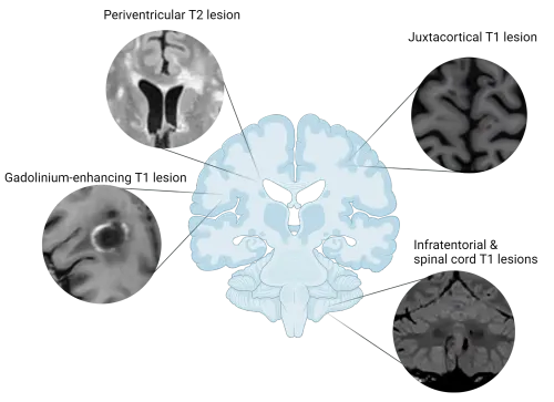 MS臨床試験におけるガドリニウム造影MRI病変